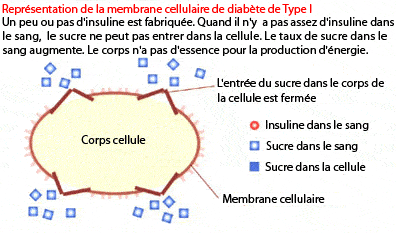 diabete-type1