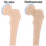 osteoporose